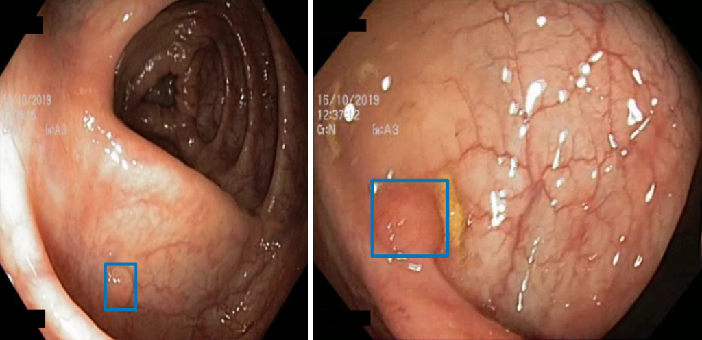 Нейросеть обраружила и отметила плипы.png Нейросеть обраружила и отметила плипы.png