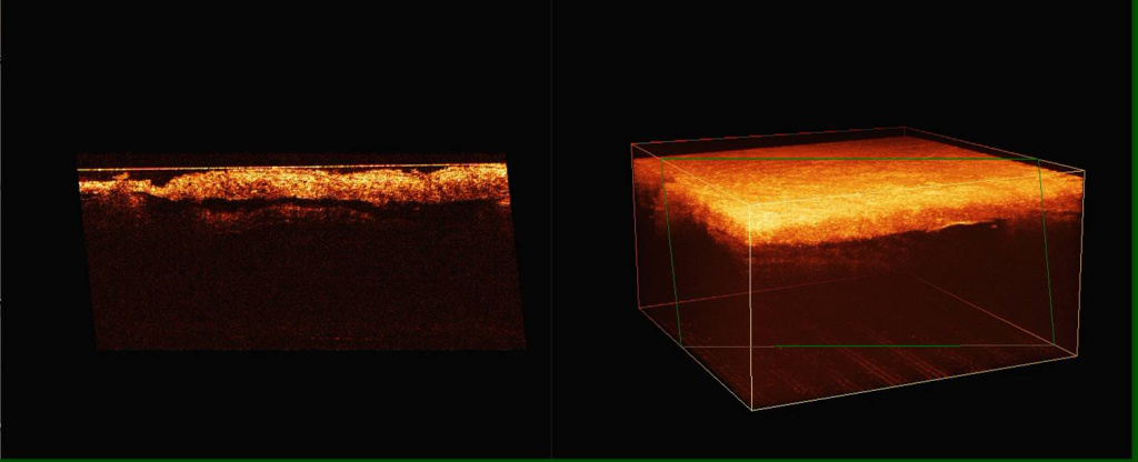 контроль восстановления – полноценная кожа толщина и структура, которой соответствуют здоровой коже.jpg